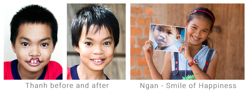 ngan and thanh - Quỹ Operation Smile Việt Nam